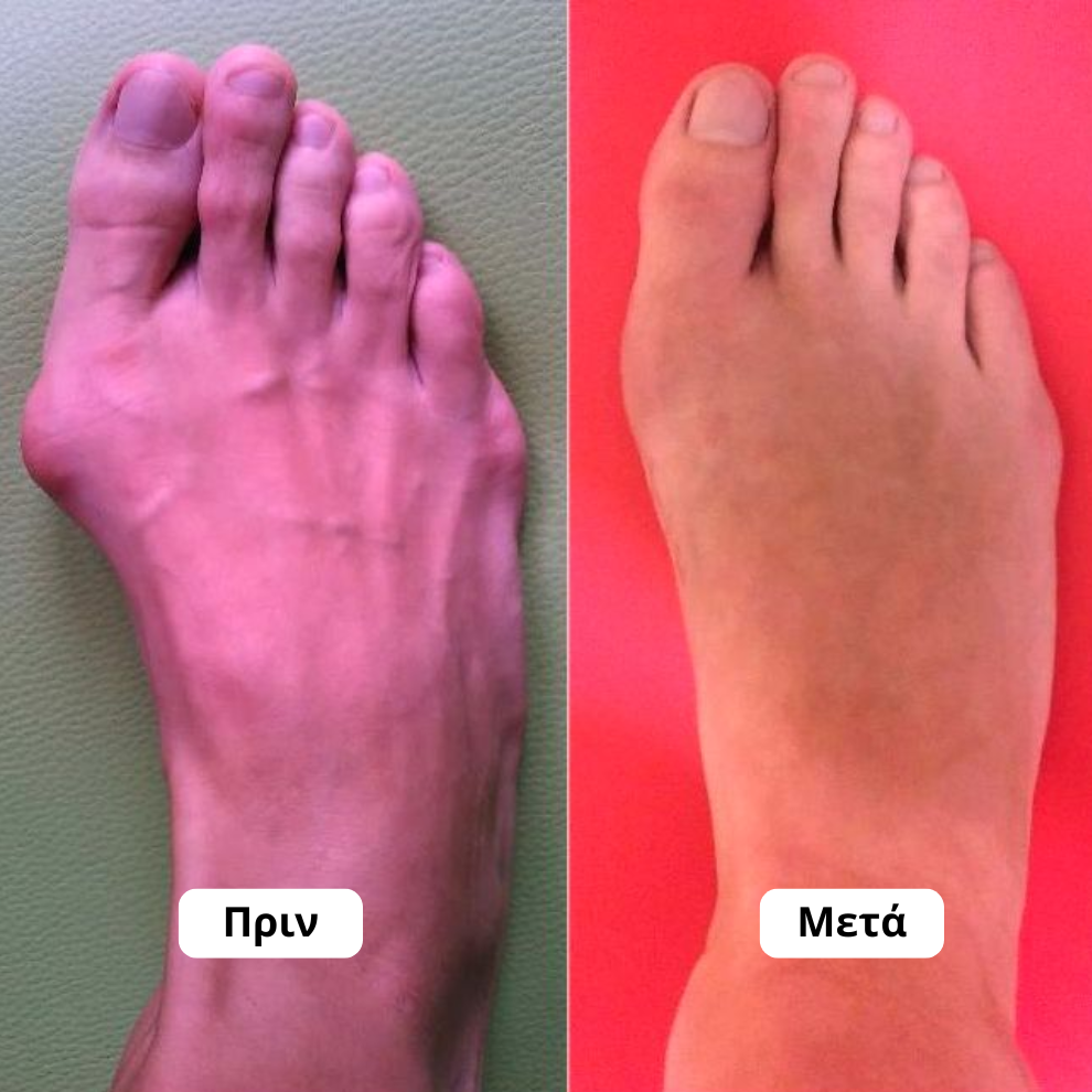 Ορθοπεδικός Νάρθηκας για Κότσι